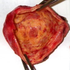 Inflamed gall bladder