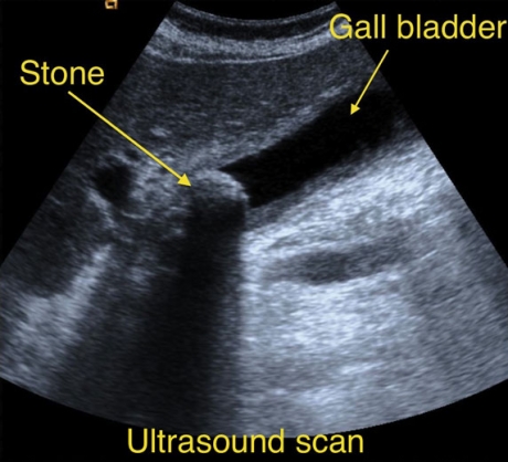 Gallstones ultrasound scan